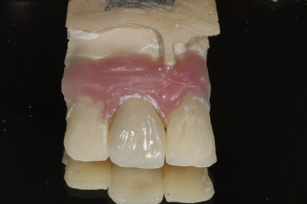  anterior Porcelain 