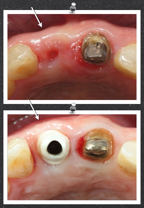 Before and after occlusal view