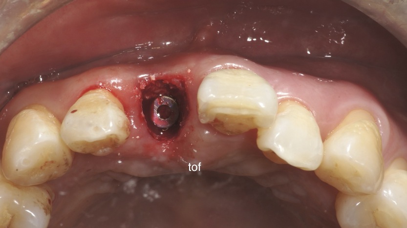 Implant placement occlusal