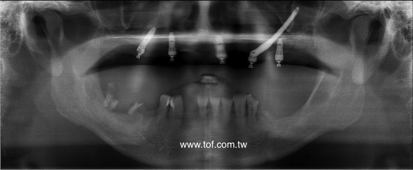 蘇新發_571001.jpg zygoma implant