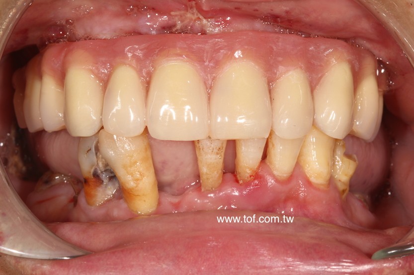 All-on-4 zygoma immediate denture.JPG zygoma implant