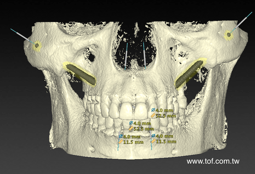  zygoma implant 