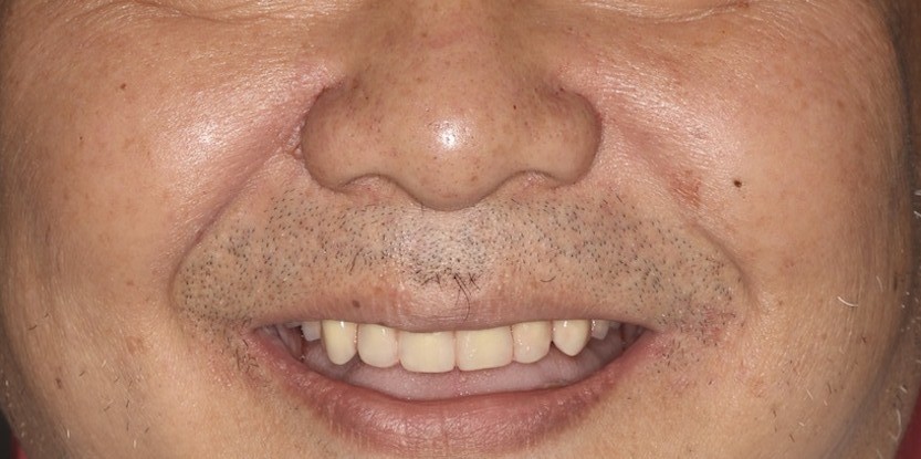 IMG_5642.jpg zygoma implant