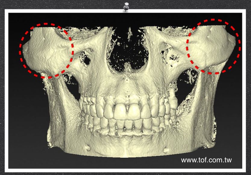  zygoma implant 