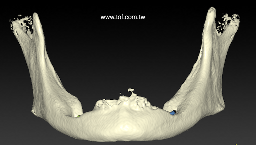 Edentulous ridge