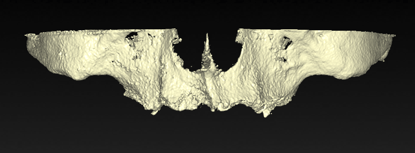 extremely absorbed maxilla frontal.png Extremely absorbed maxilla frontal