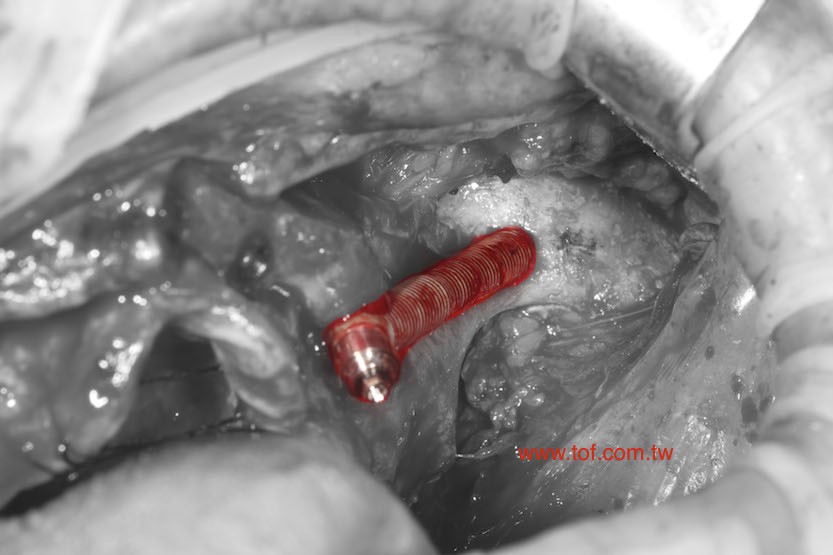 left zygomatic implant.jpg zygoma implant