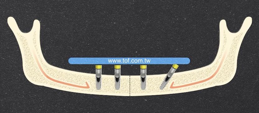 Tilted implant 022