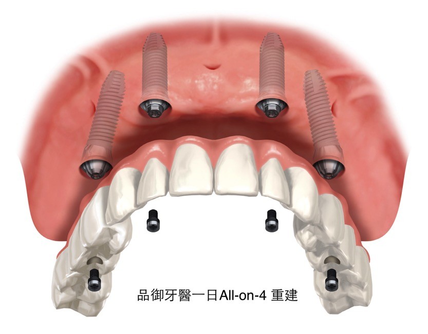 6679.JPG All-on-4