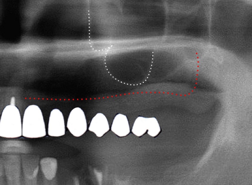 Maxillary sinus