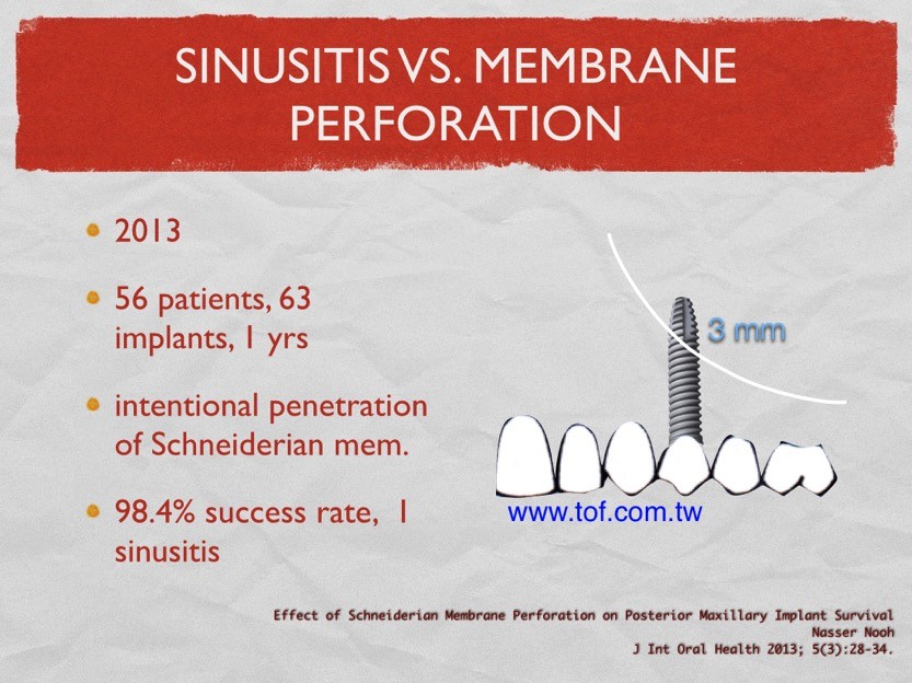Sinus implant 001