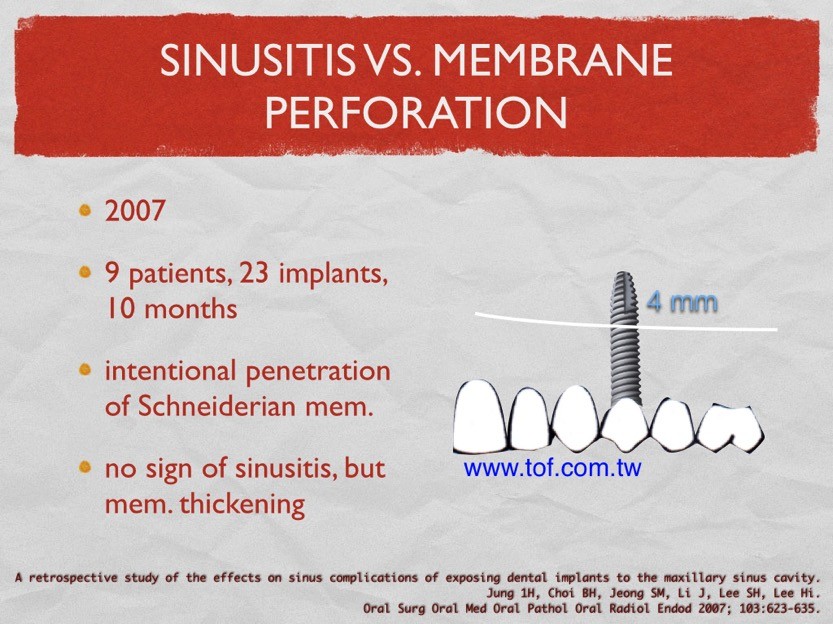 Sinus implant 002