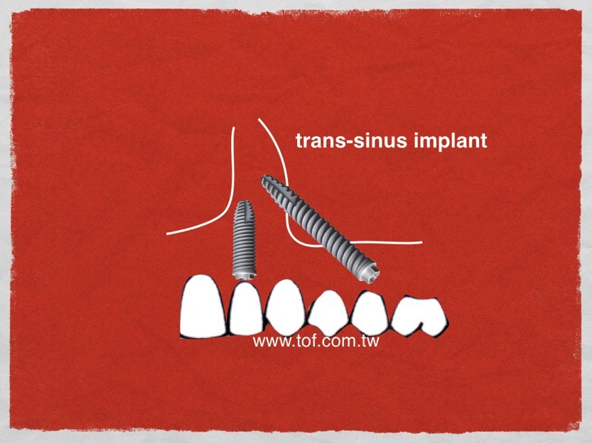 Trans implant