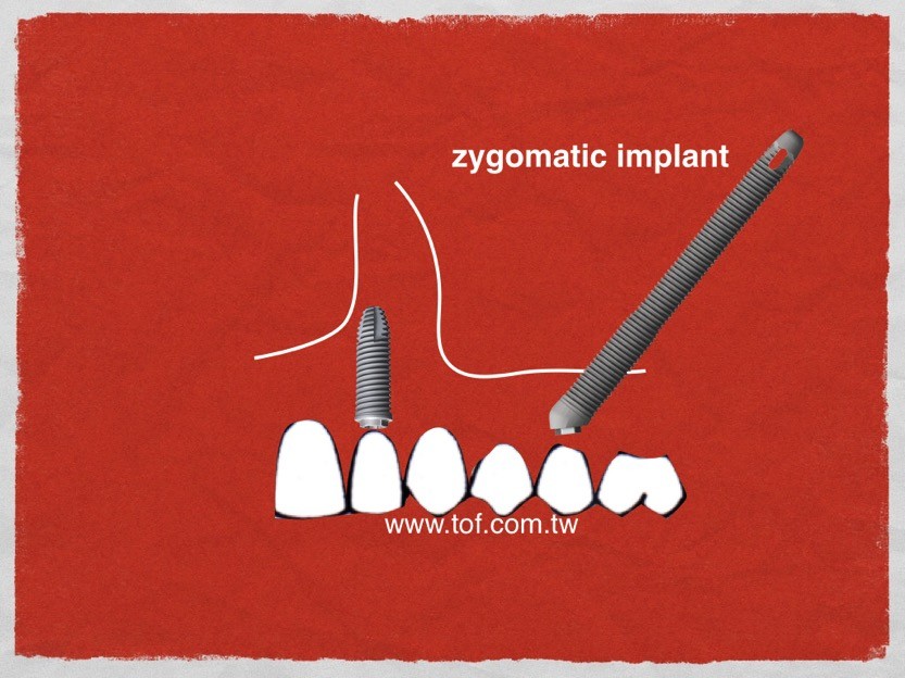 Zygomatic implant