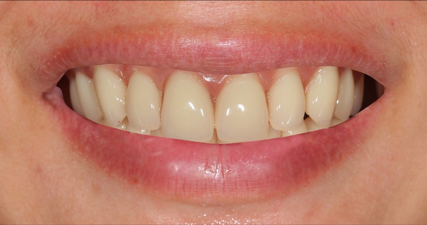 Smile simulation after