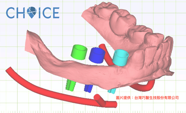 004.png 人工植牙