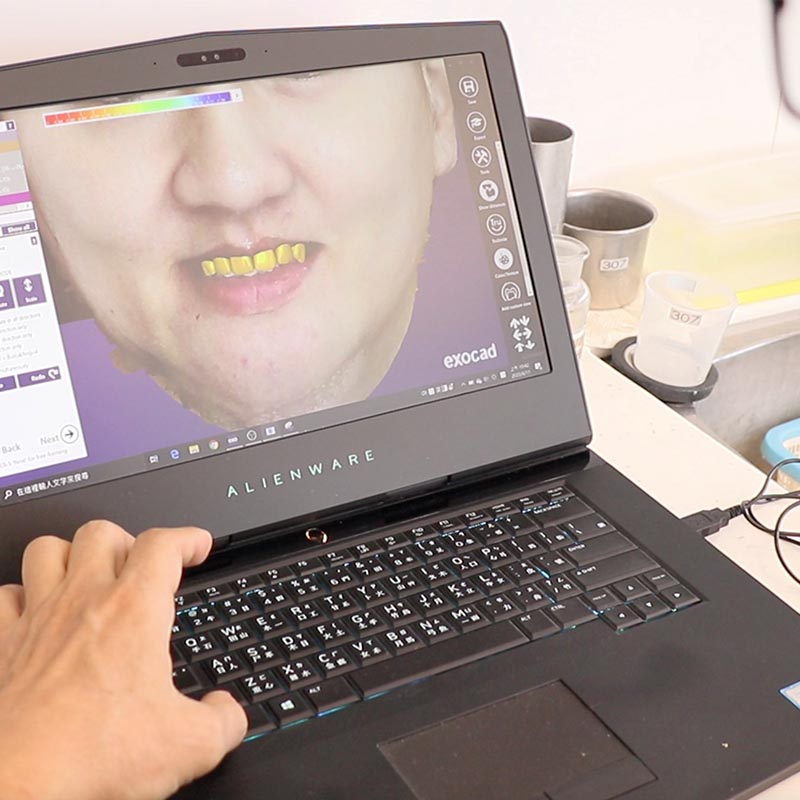 電腦內先設計假牙，再決定怎麼植牙
