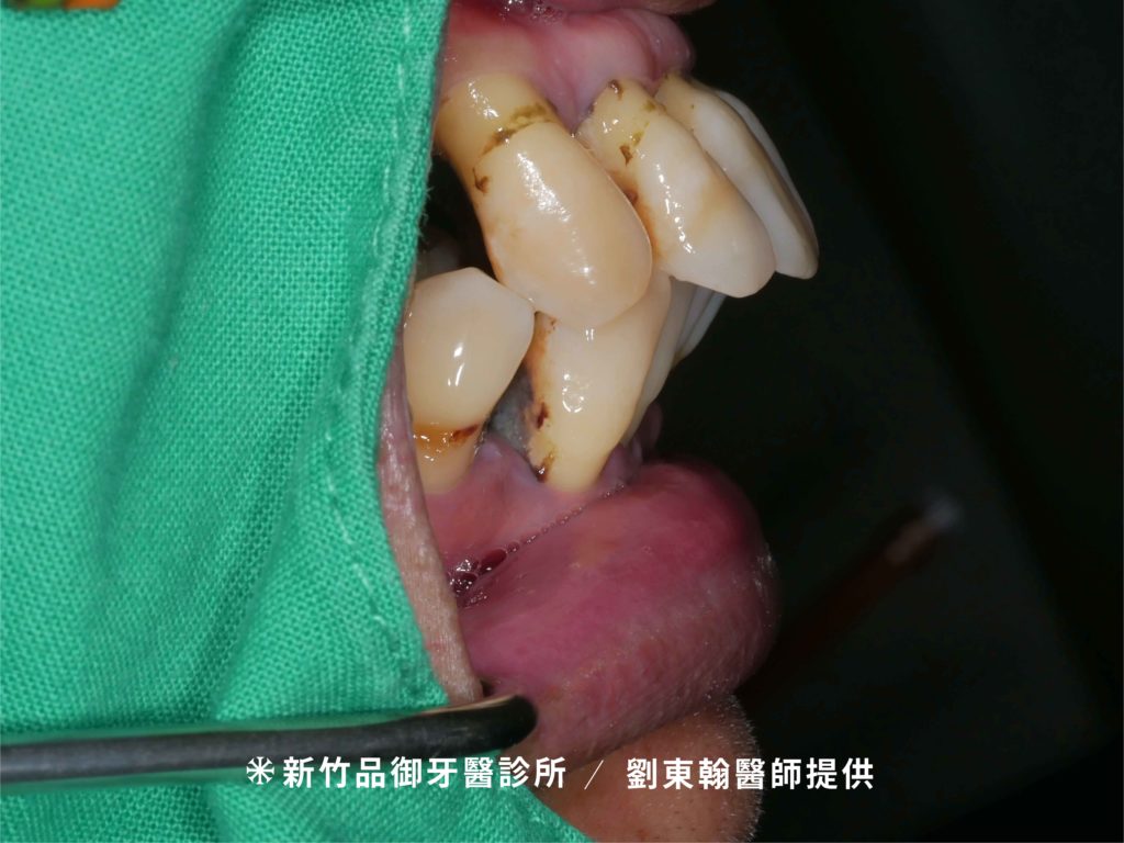 後牙缺牙，容易導致前牙暴牙