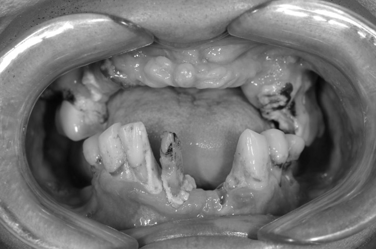 全口重建前，牙周病嚴重、多顆缺牙